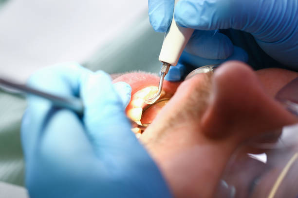 Best Broken or Chipped Tooth Repair in Union City, OH